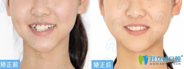 青少年安氏I类错合固定矫治案例及对比效果