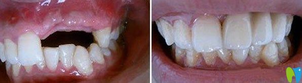 朱辉主任真人牙齿种植案例效果对比图