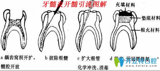 急性牙髓炎的处理方法图解