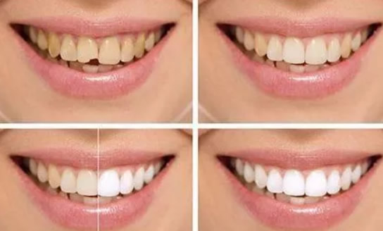 关于牙齿贴面多少钱一颗能维持多久+牙齿贴面优缺点的叙述