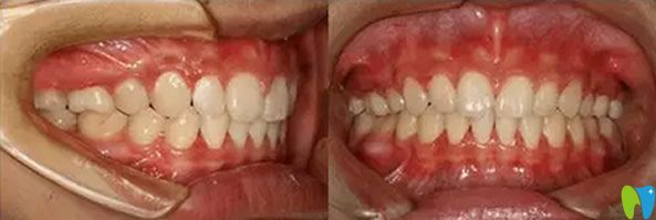 牙齿矫正一年的效果