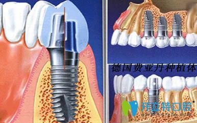 列举德国种植牙品牌有哪些以及费亚丹/icx/bego种植系统简介