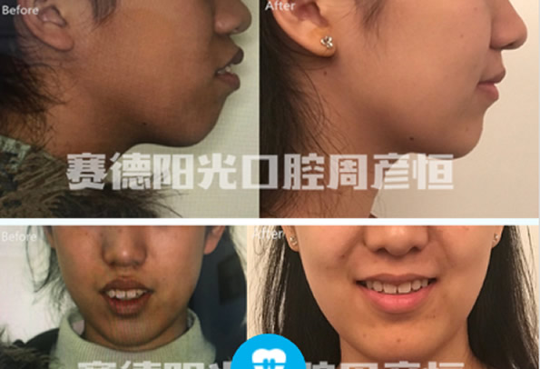 骨性龅牙怎么矫正带牙套有用吗 深圳赛德阳光口腔正畸贵吗