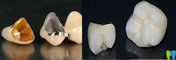 所选择的补牙材料影响补牙的价格