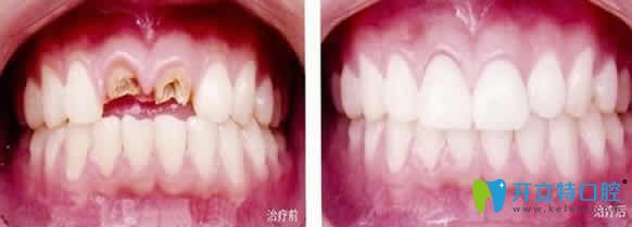 重庆嘉悦口腔即刻种植牙效果图