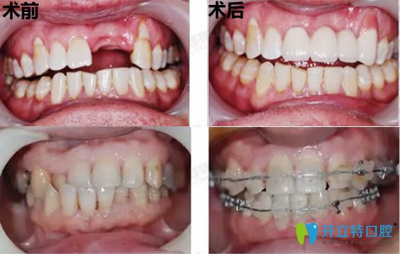 郑州拜博口腔老年人即刻种植牙案例和28岁矫正牙齿前后对比照