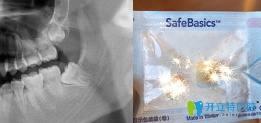 <!--<i data=20240703-sp></i>-->口腔朝阳北路拔智齿