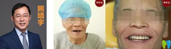 北京拜博口腔熊靖宇全口牙缺失种植效果案例
