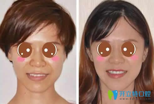 我在兰州惠安齿科做牙齿矫正前后对比照片 我在兰州惠安齿科做牙齿矫正前后对比照片