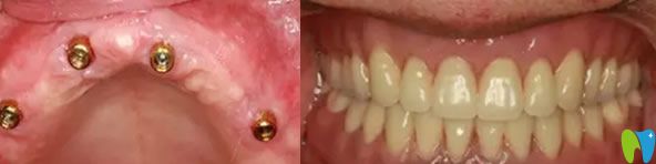 上海雅悦齿科全口无牙种植牙前后效果对比图