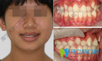 14岁孩子在南宁天使口腔成功矫正牙齿不齐/反颌的案例分享