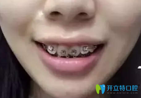 在东莞好佰年口腔做牙齿正畸戴牙套第1天 在东莞好佰年口腔做牙齿正畸戴牙套第1天