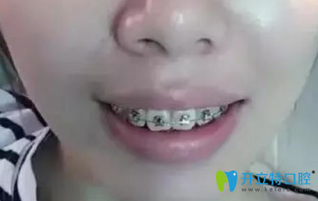 找东莞好佰年口腔张春利做牙齿矫正第88天变化图 找东莞好佰年口腔张春利做牙齿矫正第88天变化图