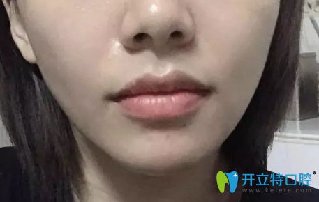 东莞好佰年口腔牙齿矫正即将完成 东莞好佰年口腔牙齿矫正即将完成