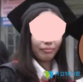 没有去东莞好佰年口腔做牙齿矫正前 没有去东莞好佰年口腔做牙齿矫正前