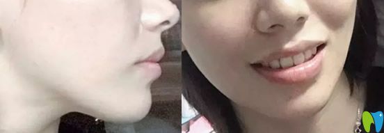 好佰年口腔牙齿矫正完成后图片 好佰年口腔牙齿矫正完成后图片