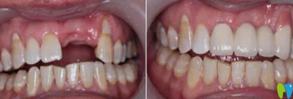 合肥世佳口腔种植牙案例效果图