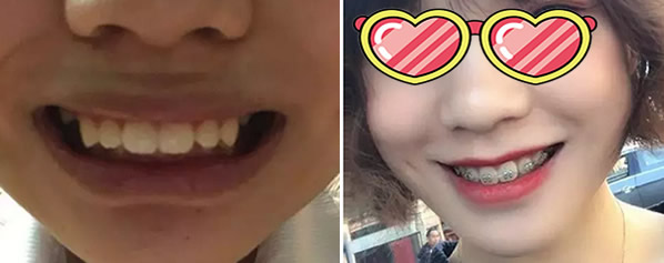 上海牙卫士口牙齿深覆颌如何矫正 我在上海牙卫士口腔带牙套快400天了