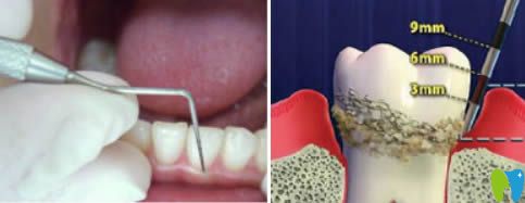 开立特口腔网：牙周病治疗图