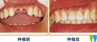 重庆种植牙哪家好？来看牙卫士口腔种植牙案例效果