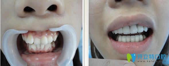 合肥世佳口腔牙齿矫正案例前后对比图