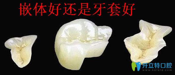 牙齿嵌体和牙套那个好 分享嵌体补牙能维持多久及修复价格
