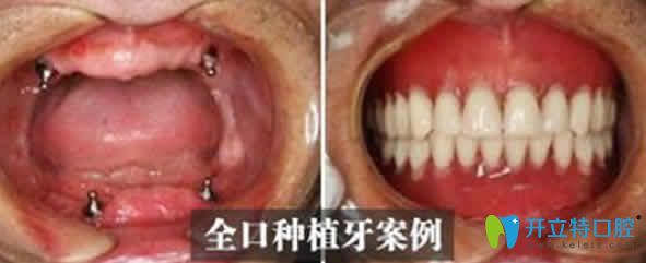 北京维尔口腔全口种植牙案例对比图
