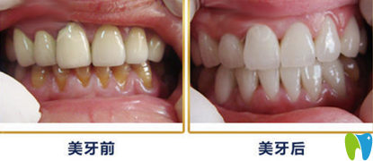 牙卫士口腔5D纳米全瓷贴面术前术后对比案例