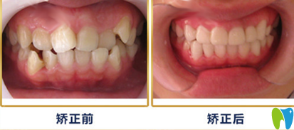 重庆牙卫士口腔牙齿矫正案例前后效果对比图