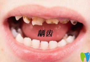 儿童龋齿影响换牙吗?牙科医生告诉你预防龋齿的方法有哪些