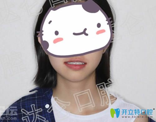 戴半隐形陶瓷牙套12个月后的矫正效果