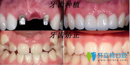 南京佑德口腔牙齿矫正和种植牙效果图 南京佑德口腔牙齿矫正和种植牙效果图
