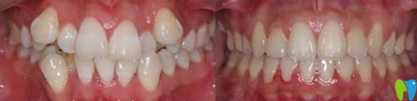 牙齿矫正前后效果对比图
