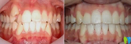 天津德倍尔口腔牙齿矫正前后对比图