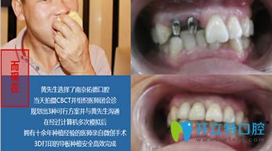 南京佑德口腔活力亲水种植牙过程舒适高效的新体验