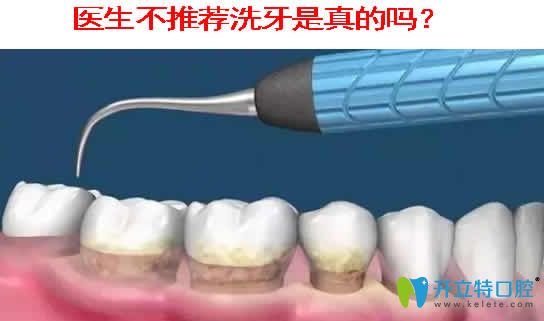 医生不推荐洗牙是真的吗 医生不推荐洗牙是真的吗
