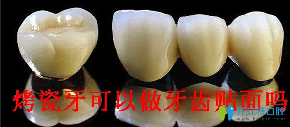 烤瓷牙可以做牙齿贴面吗 烤瓷牙可以做牙齿贴面吗