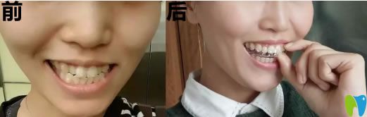 深圳乐莎莎口腔成人牙齿拥挤矫正前后对比照及脸型变化图
