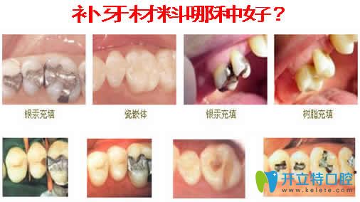 补牙材料哪种好 提供补牙材料有哪些及价格表 牙科治疗 开立特口腔