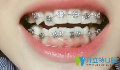 在武汉第 一口腔医院做牙齿正畸前图片