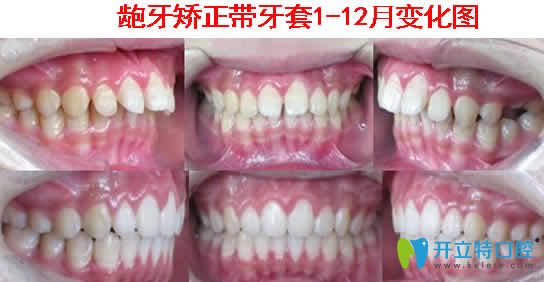 龅牙矫正带牙套1到12个月变化图