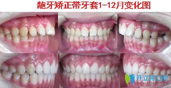 龅牙矫正带牙套1到12个月变化图 龅牙矫正带牙套1到12个月变化图
