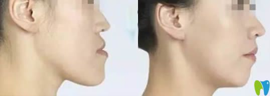 福州维乐口腔郭淑苹医生地包天矫正案例及前后对比照