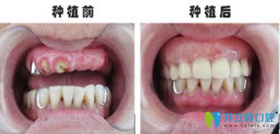 宁波协禾口腔王昭文院长种植牙案例效果图 宁波协禾口腔王昭文院长种植牙案例效果图