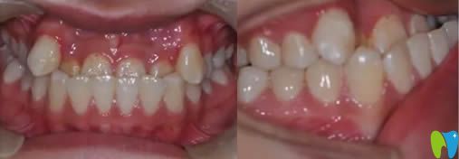 西安植德口腔地包天牙齿矫正前照片