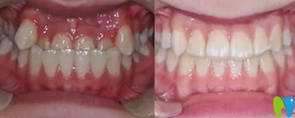 西安植德口腔牙齿正畸真人案例:让牙齿成功脱离“地包天