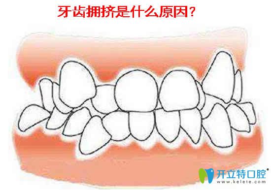 牙齿拥挤是什么原因