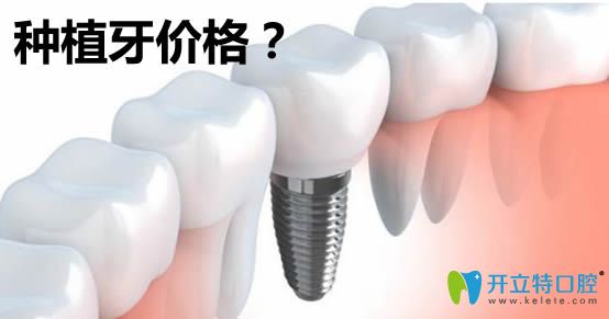 牙齿种植价格多少钱一颗 牙齿种植价格多少钱一颗