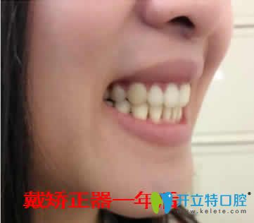 我在天津爱齿口腔做牙齿矫正一年效果照片