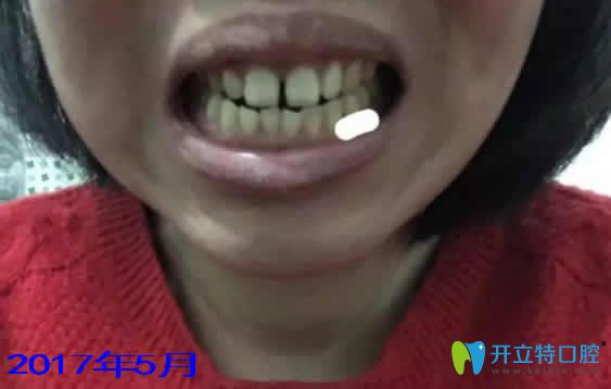 我在宁波协禾口腔做牙齿矫正前的照片